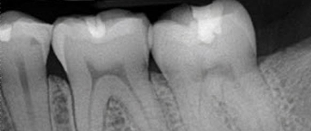 Plastic Dental Imaging