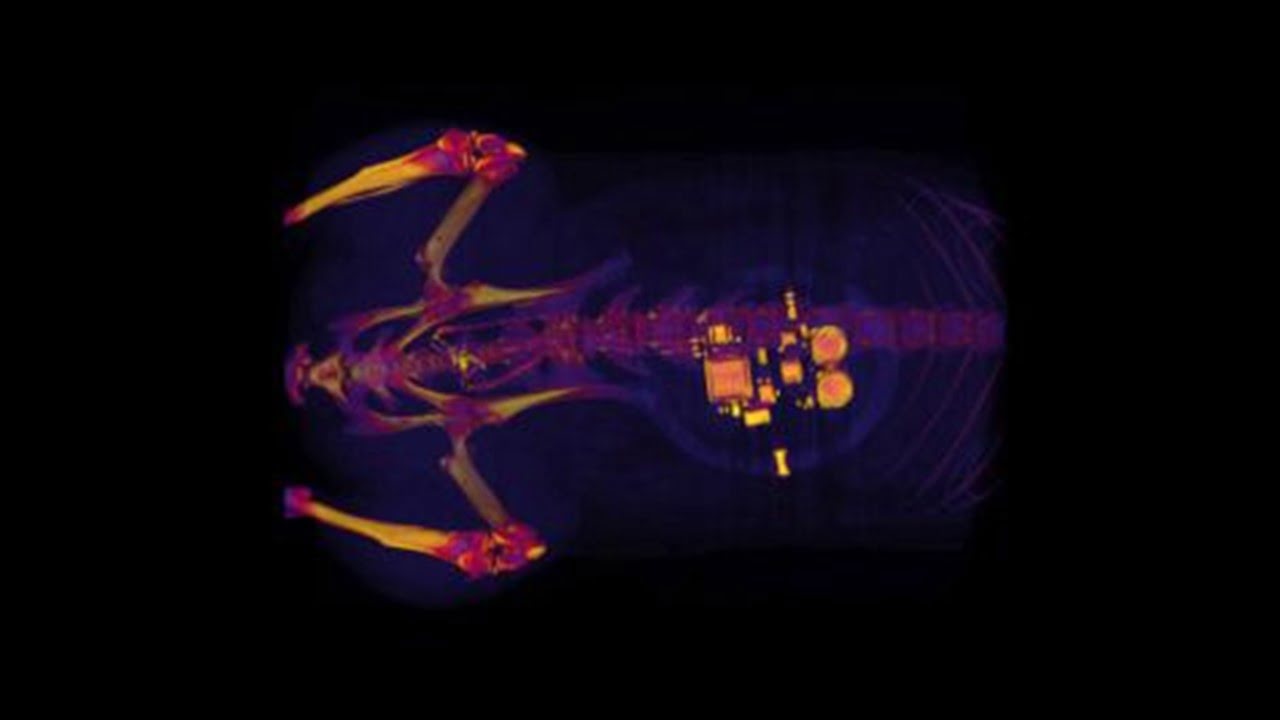 Implantable Device Treats Severe Bladder Issues